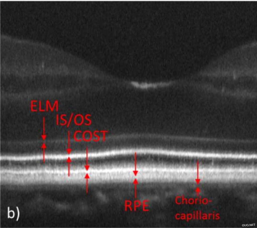 健康人眼黄斑区AO-OCT B-scan图像解读
